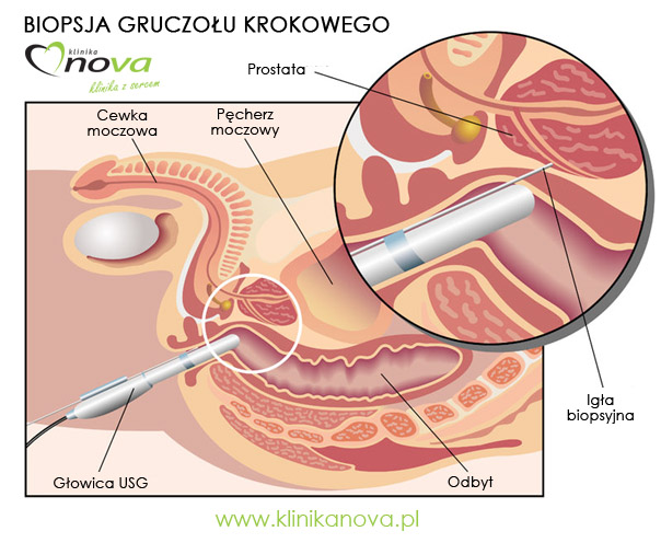 Klinika Nova - Biopsja prostaty